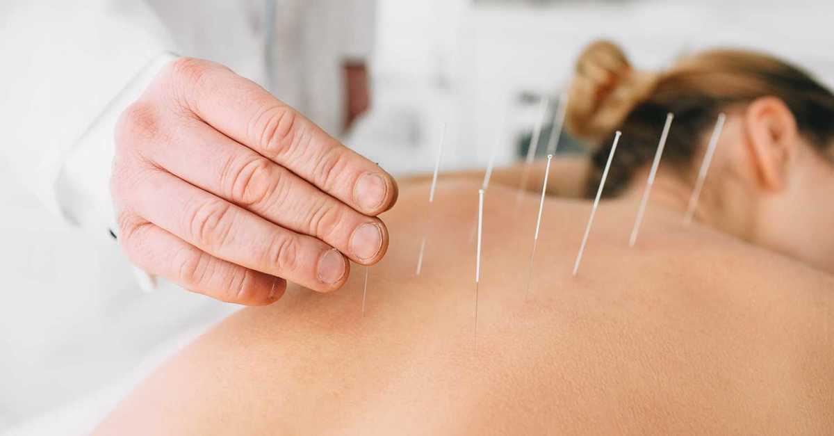 Acupuncture Services in Holland Landing | Medical Acupuncture Treatment