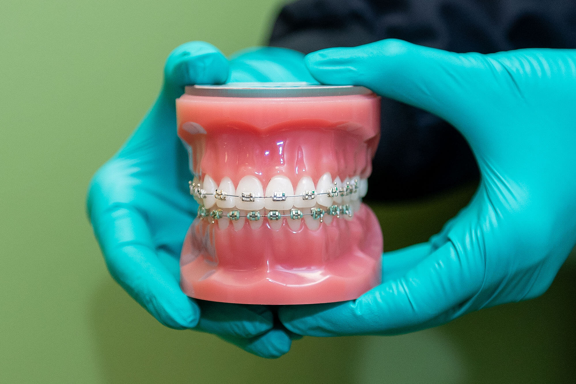 North Asheville Braces | Hendersonville Braces | Arden Braces | Weaverville | Waynesville Braces | Sylva | Marion | Biltmore Forest | Franklin | Brevard | Morganton | Swannanoa | Cullowhee | Mars Hill | Hayesville Braces | NC